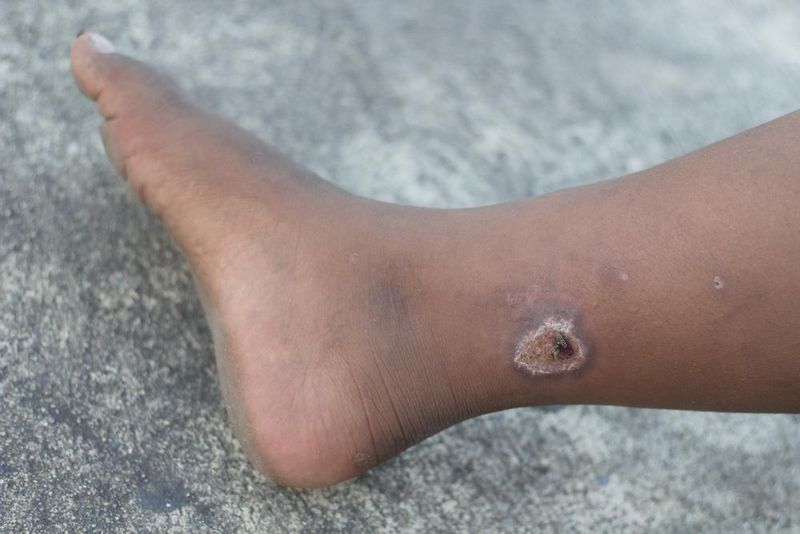 Wound Maceration Management Wound Maceration Prevention